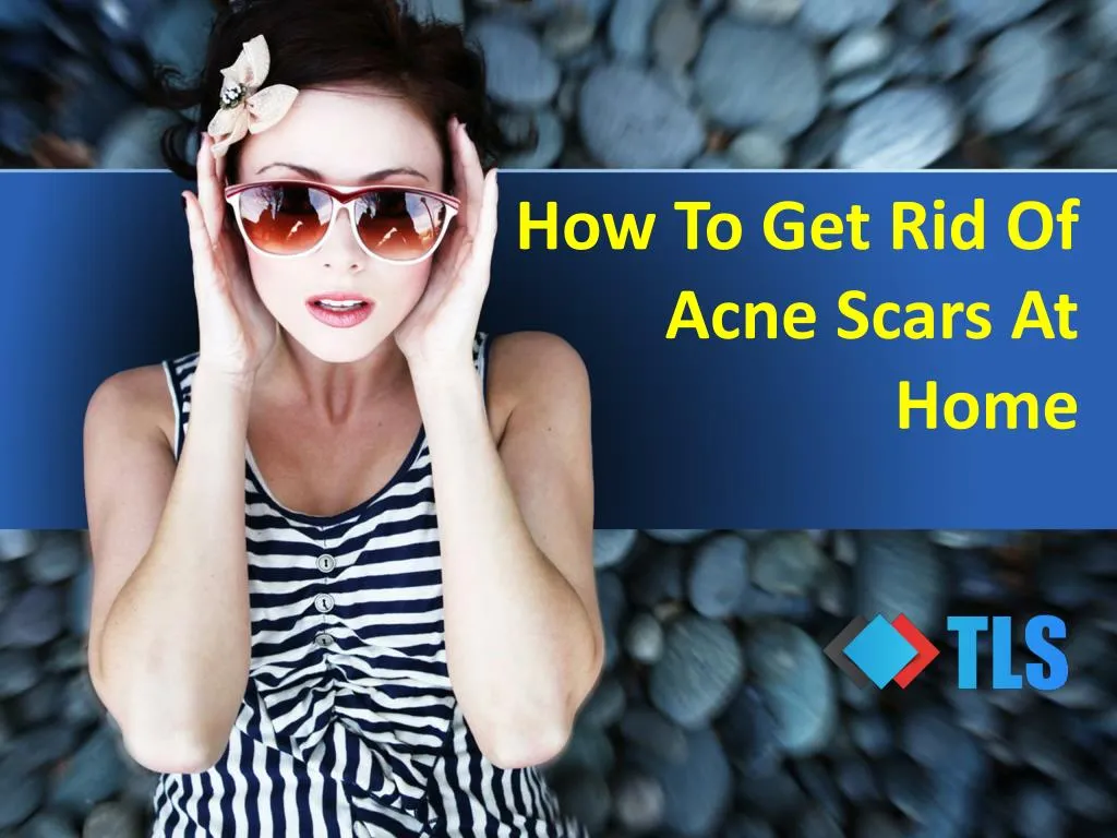how to get rid of acne scars at home