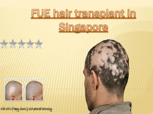 FUE hair transplant in Singapore