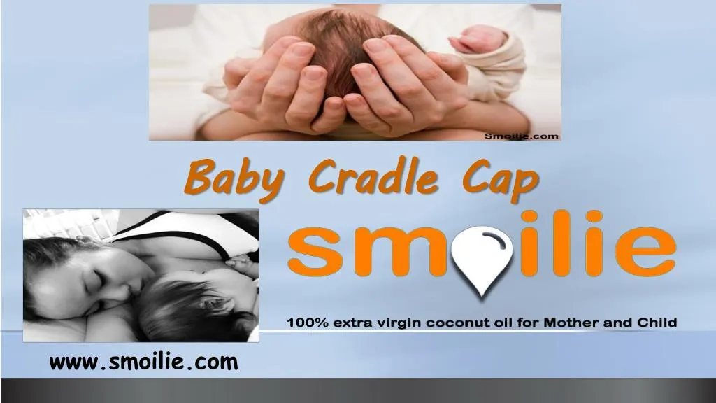 baby cradle cap