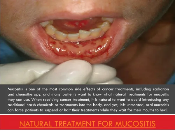 Natural cure for mucositis