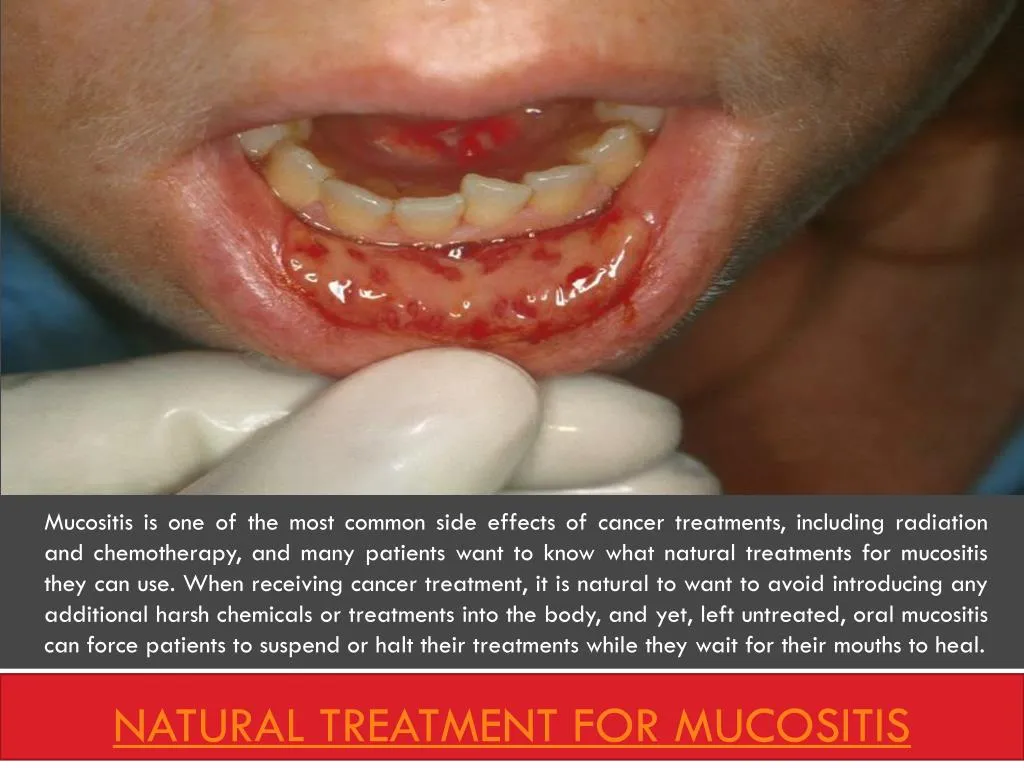 natural treatment for mucositis