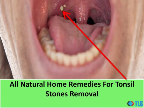All Natural Home Remedies For Tonsil Stones Removal