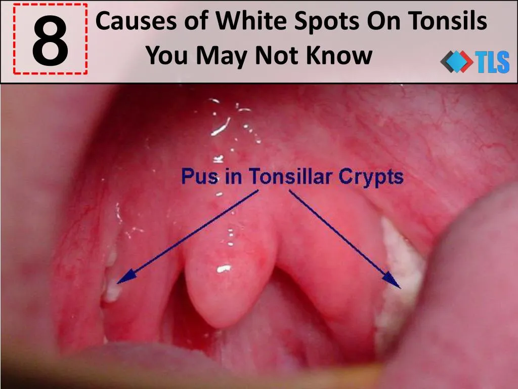 causes of white spots on tonsils you may not know