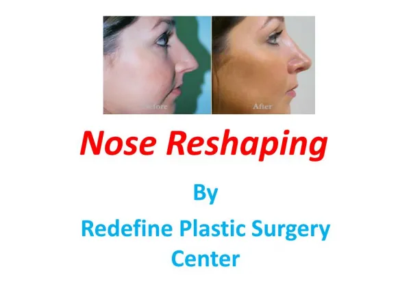 Nose Reshaping Surgery in hyderabad