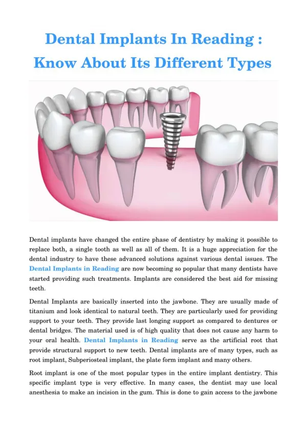 Dental Implants Reading Pa