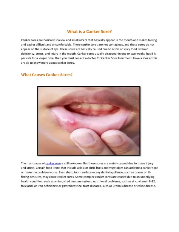What is a Canker Sore?