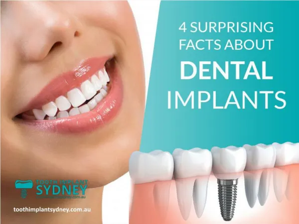 Surprising Facts on Dental Implants!