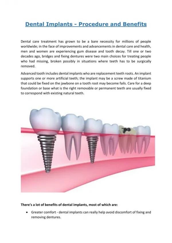 Dental implants - procedure and benefits
