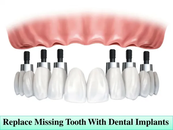Replace Missing Tooth With Dental Implants