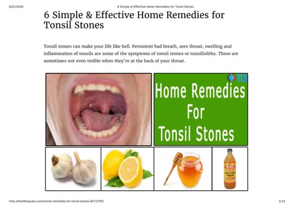 6 Home Remedies for Tonsil Stones