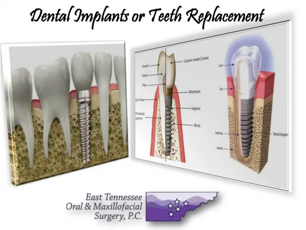 Dental Implants Medical Services by Etoms