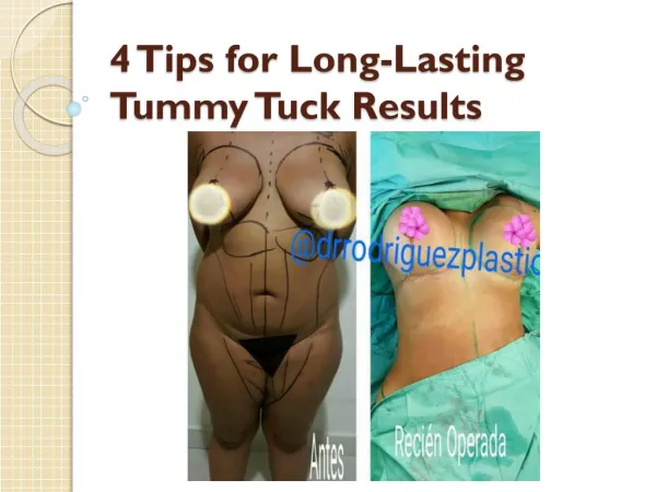 4 Tips for Long-Lasting Tummy Tuck Results