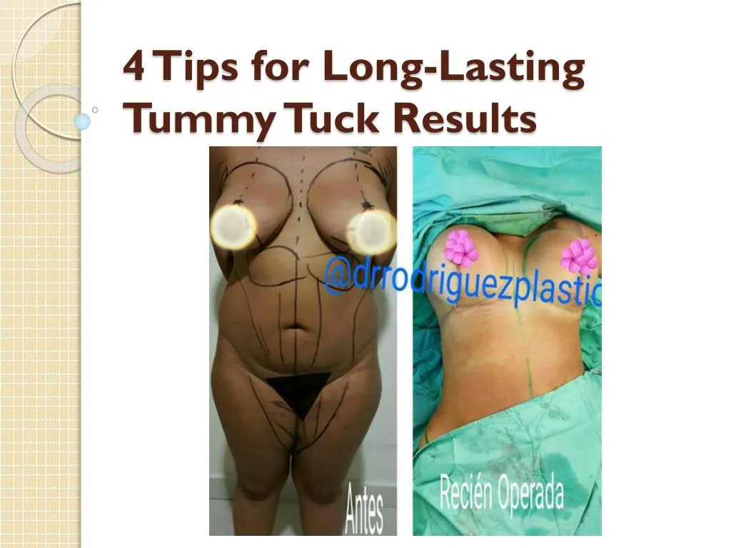 4 tips for long lasting tummy tuck results
