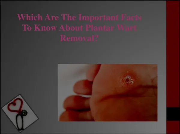Which Are The Important Facts To Know About Plantar Wart Removal