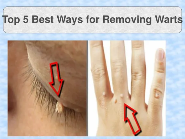 Top 5 Best Ways for Removing Warts
