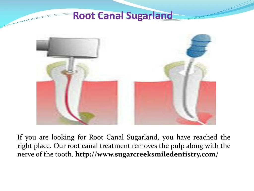 root canal sugarland