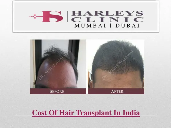 Cost Of Hair Transplant In India