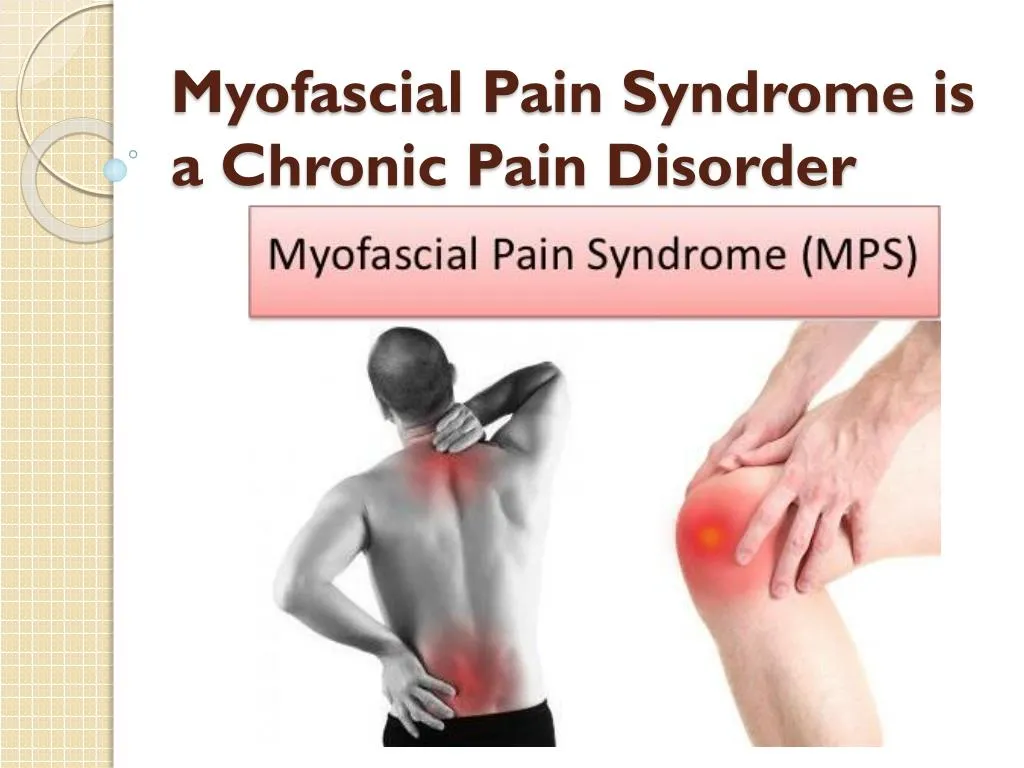 myofascial pain syndrome is a chronic pain disorder