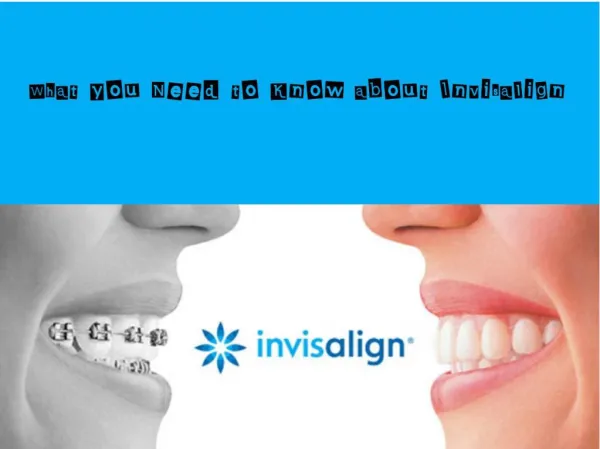 What you Need to Know about Invisalign