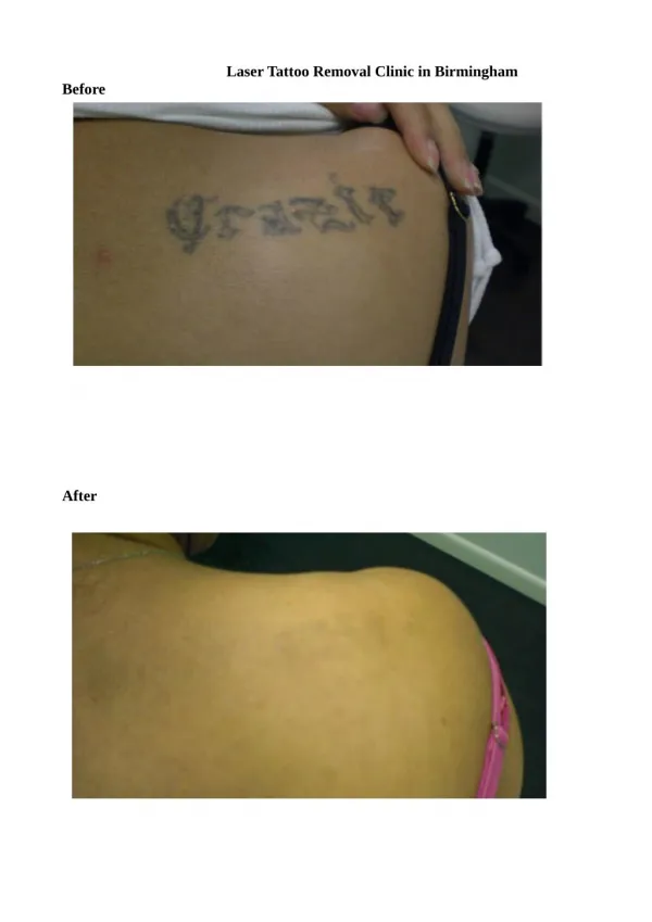 Laser Tattoo Removal Clinic in Birmingham