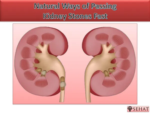 Natural Ways of Passing Kidney Stones | Sehat.com