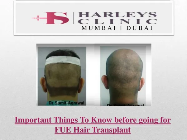 Important Things To Know before going for FUE Hair Transplant