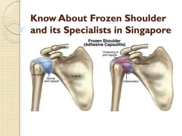 Know About Frozen Shoulder and its Specialists in Singapore