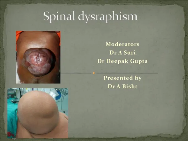 spinal dyspharisam