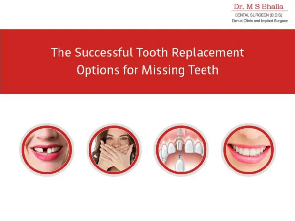 The Successful Tooth Replacement Options for Missing Teeth