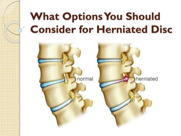 What Options You Should Consider for Herniated Disc