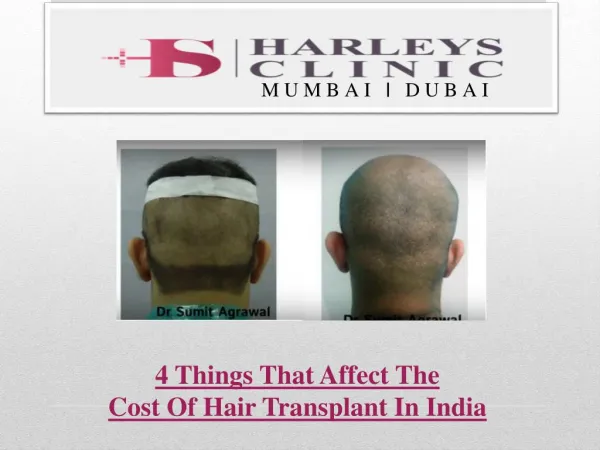 4 Things That Affect The Cost Of Hair Transplant In India