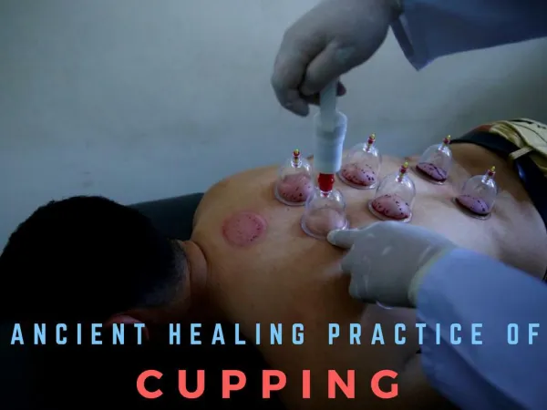Ancient healing practice of cupping