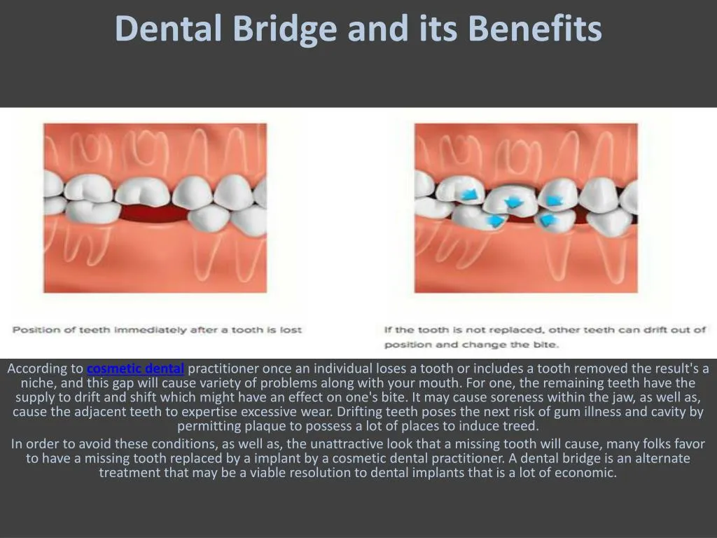 dental bridge and its benefits