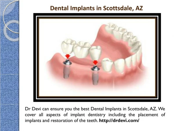 Implant Dentist in Scottsdale, AZ