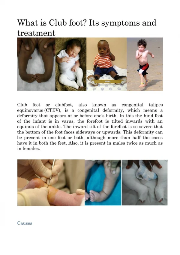 What is Club foot? Its symptoms and treatment.