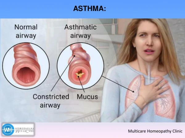 What is Asthma ? How Can Asthma Be Prevented?