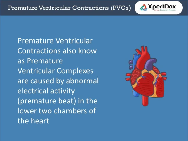 Premature ventricular contraction
