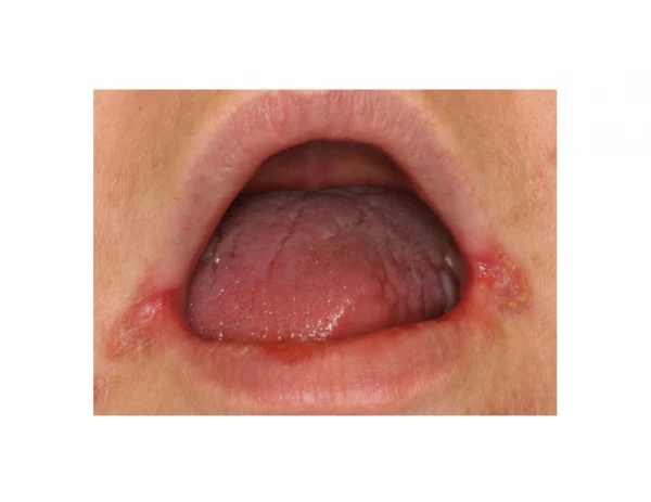 Cracked Corners Of Mouth, Cheilitis, Angular Cheilitis Remedy, Angular Cheilitis Medicine, Cheilitis