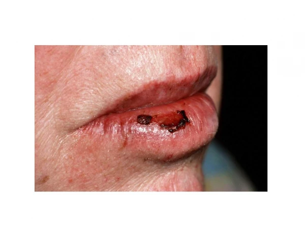 Cracks At Corner Of Mouth, Chelitis, Antifungal Cream For Angular Cheilitis, Treat Angular Cheilitis