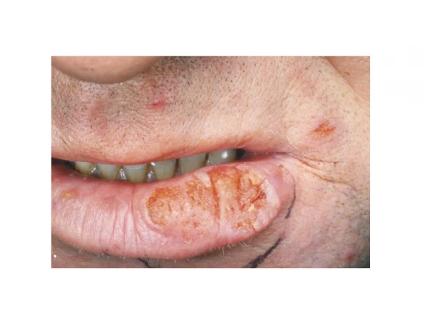 Cut In Corner Of Mouth, Angular Chelitis, Angular Cheilitis Pictures, Angular Cheilitis Vitamin
