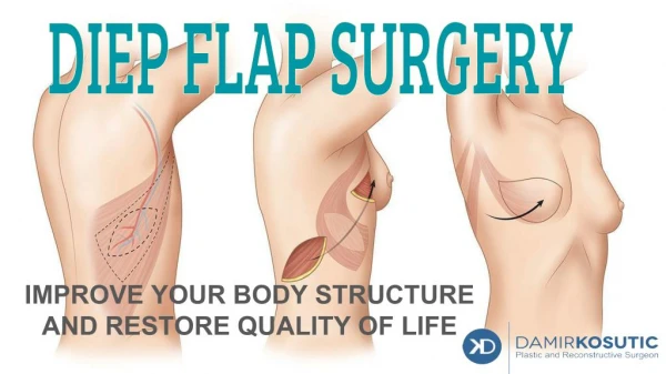 Know in Details About DIEP FlAP Surgery in Manchester