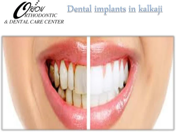 Dental implants in kalkaji