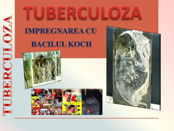 tuberculoza