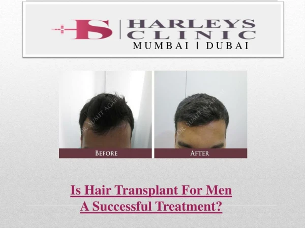 Is Hair Transplant For Men A Successful Treatment?