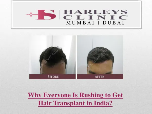Why Everyone Is Rushing to Get Hair Transplants?