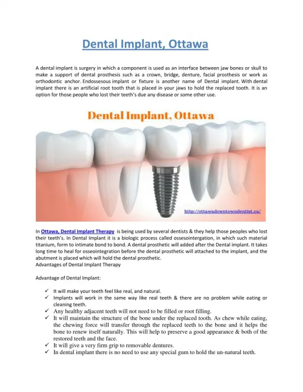 Dental Implant, Ottawa