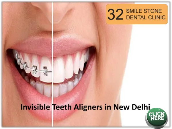 Invisible Teeth Aligners in New Delhi