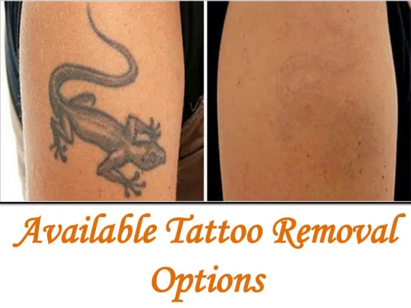Available Tattoo Removal Options