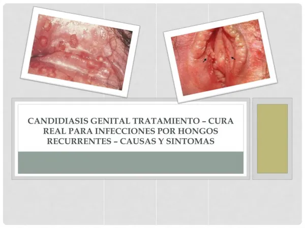 Candidiasis Genital Tratamiento – Cura Real para Infecciones por Hongos Recurrentes – Causas y Sintomas