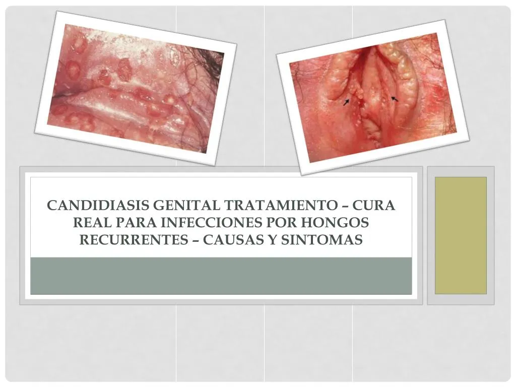 candidiasis genital tratamiento cura real para infecciones por hongos recurrentes causas y sintomas